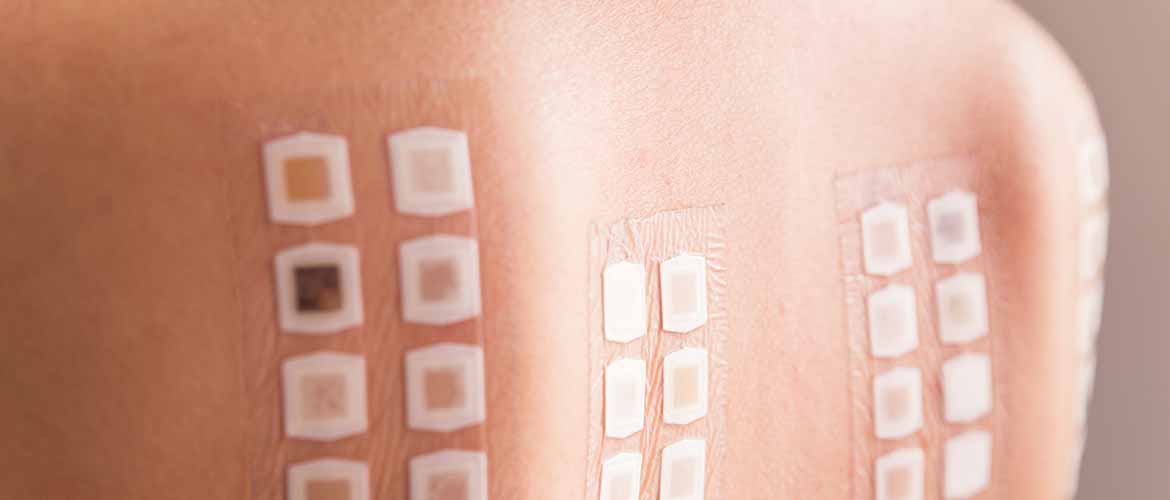 allergy patch test on the back of a young woman