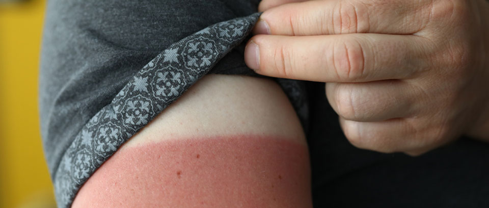 person showing sun burn on arm