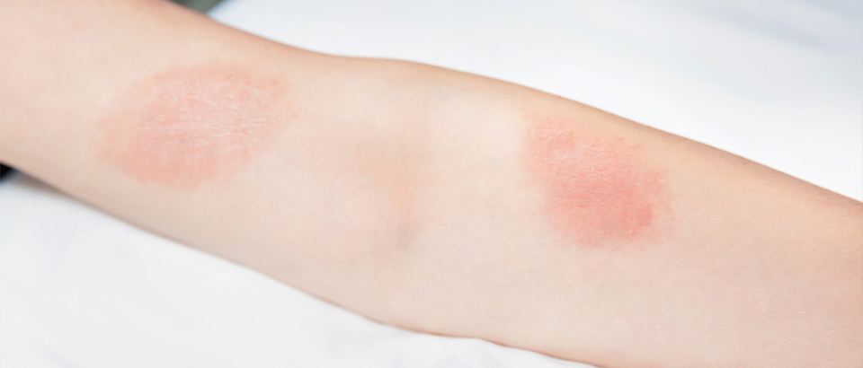 poison ivy rash on an arm